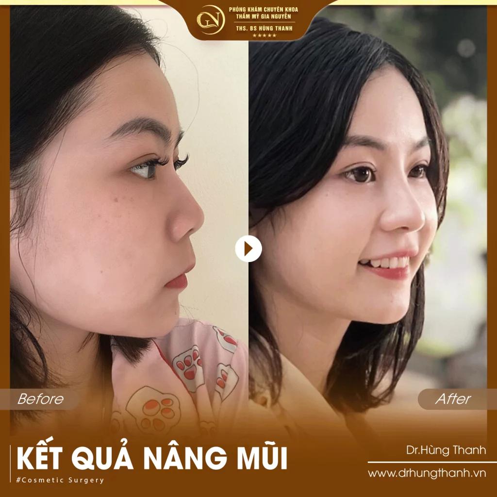 Khách hàng nâng mũi