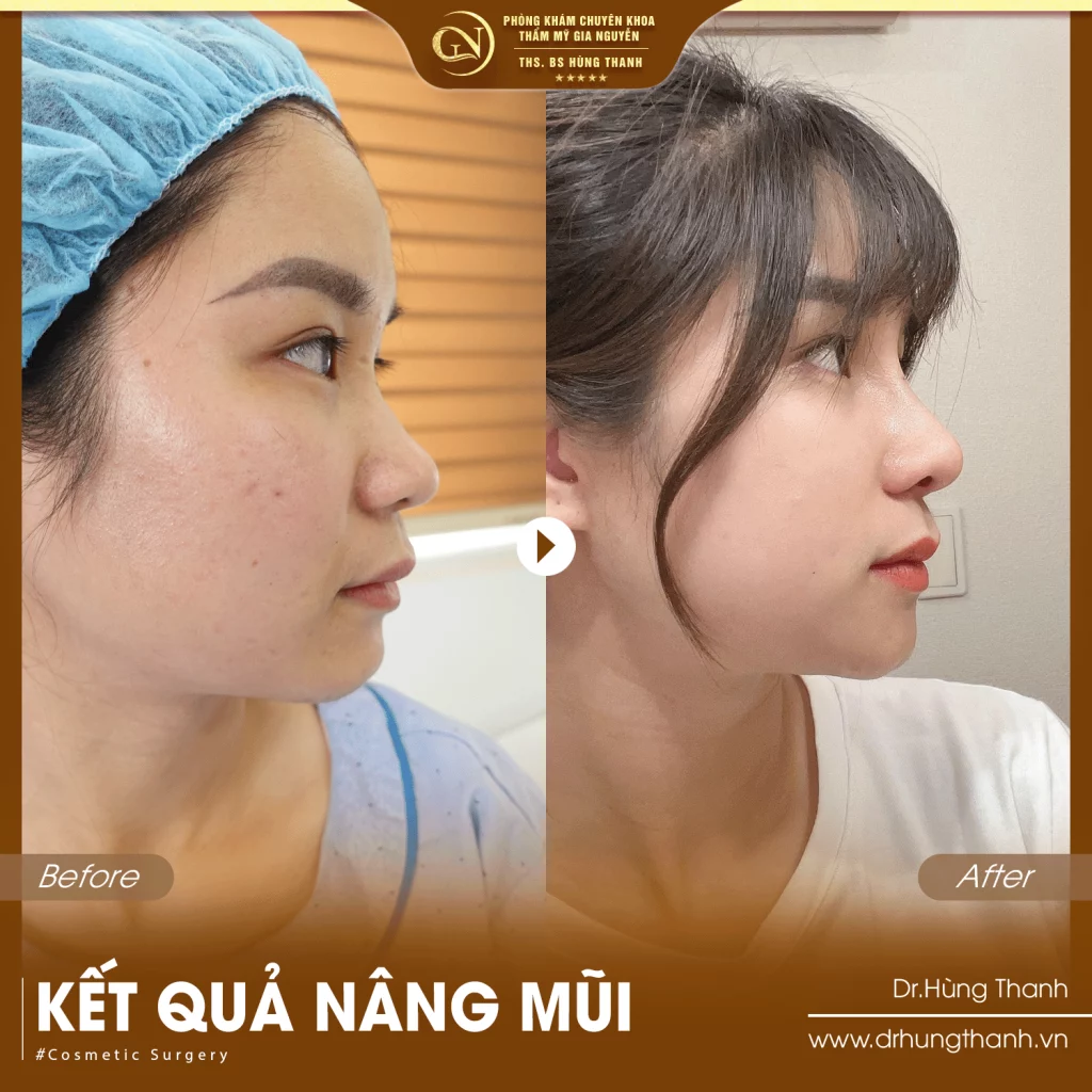 Khách hàng nâng mũi