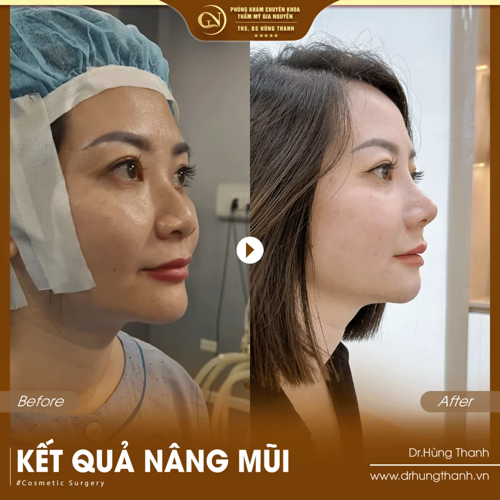 Khách hàng nâng mũi