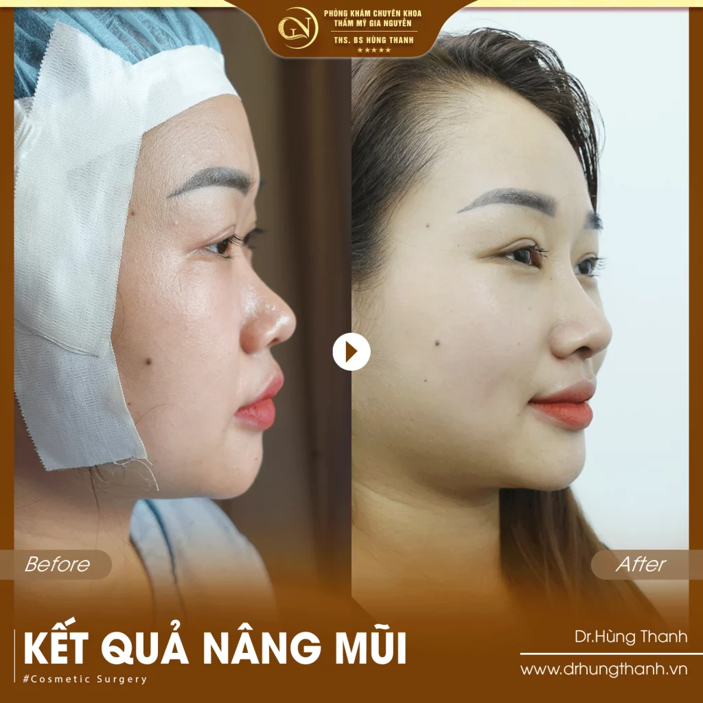 Khách hàng nâng mũi