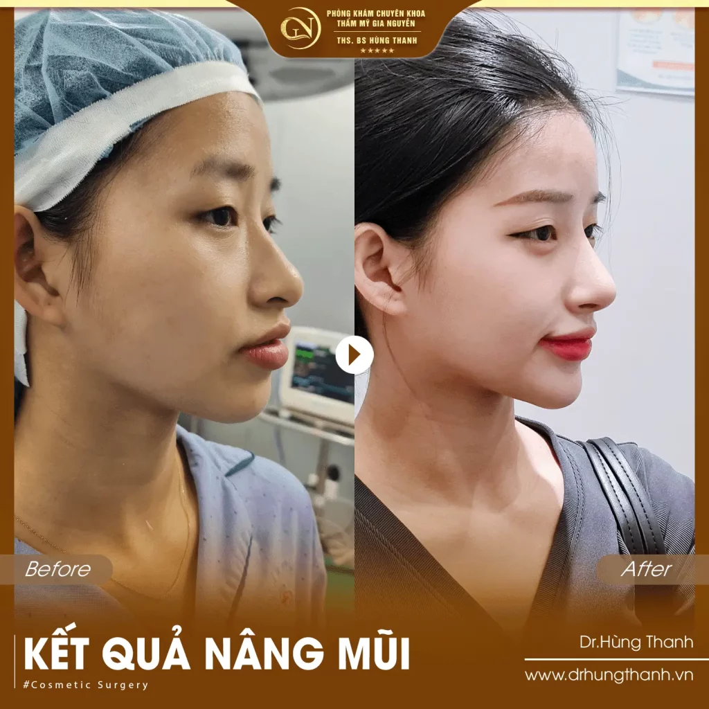 Khách hàng nâng mũi