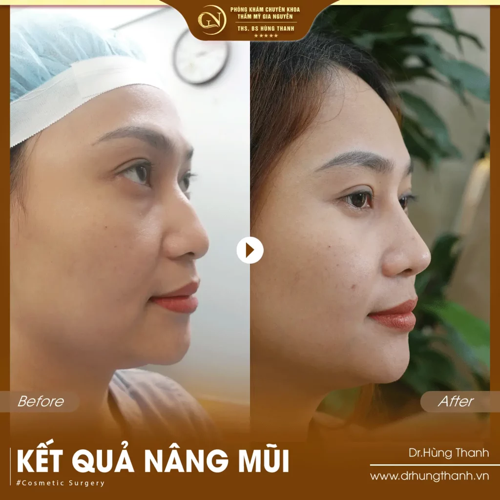 Khách hàng nâng mũi 1
