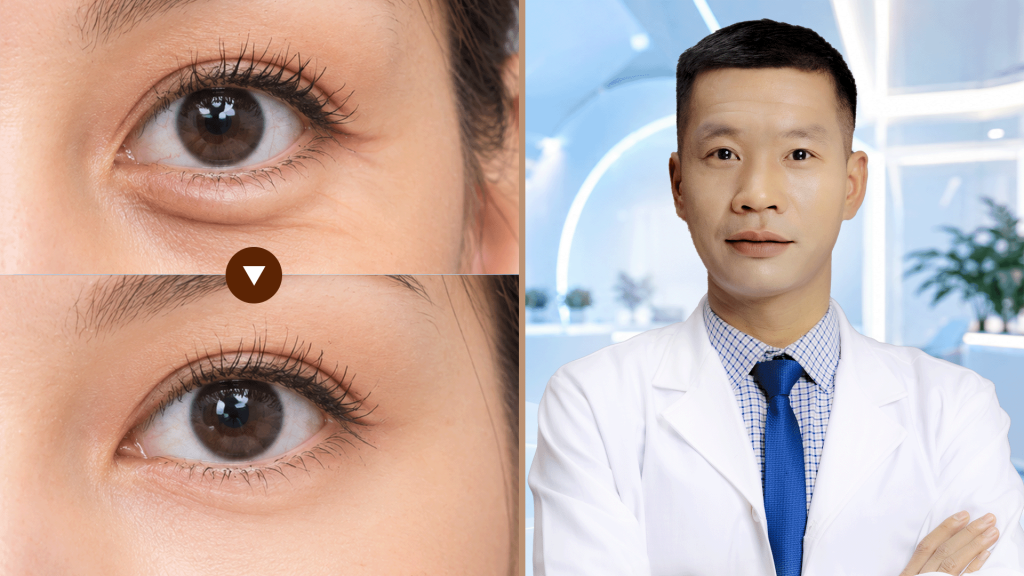 Cắt mí dưới
